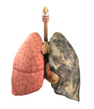 Bronchogenic Carcinoma